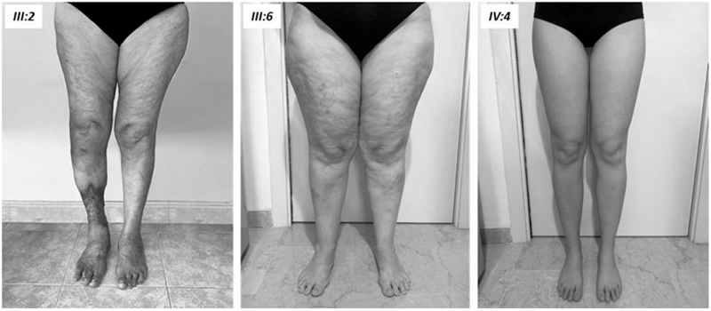 mutazione genetica legata al lipedema primario non sindromico