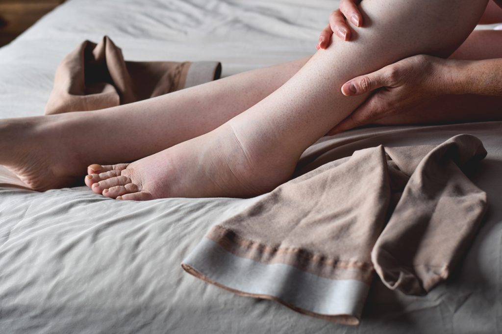 Cos'è il LINFEDEMA